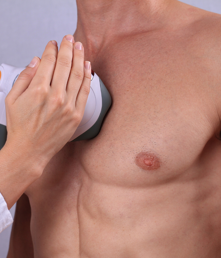 Laser Hair Removal Services for Men in Dubai